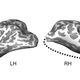 A representation of the brain matter the patient had removed from his right brain hemisphere at age six.